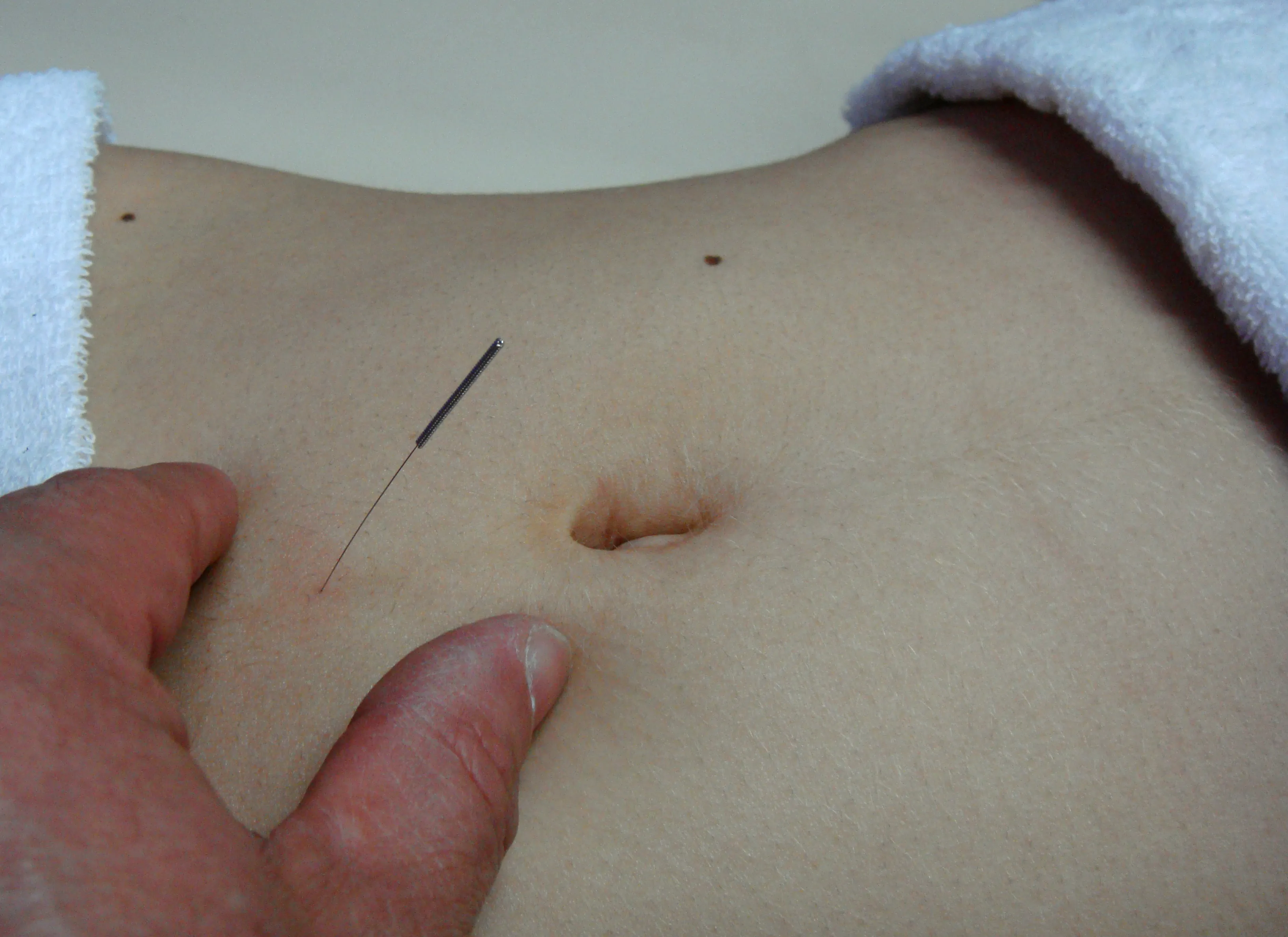 Acupuntura Sistêmica